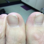 Ingrown Toenail Surgery & Post Op Care 1 Pre surgery1 150x150 Ingrown Toenail Surgery & Post Op Care