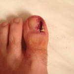 Ingrown Toenail Surgery & Post Op Care 11 Day1 RemoveBandageLeftToe 150x150 Ingrown Toenail Surgery & Post Op Care