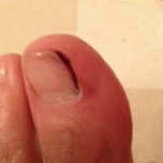 Ingrown Toenail Surgery & Post Op Care 14 Day1 AfterBrushing 150x150 Ingrown Toenail Surgery & Post Op Care