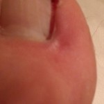 Ingrown Toenail Surgery & Post Op Care 15 Day2 LeftToe 150x150 Ingrown Toenail Surgery & Post Op Care