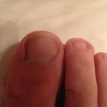 Ingrown Toenail Surgery & Post Op Care 16 Day2 RightToe 150x150 Ingrown Toenail Surgery & Post Op Care