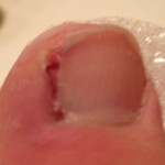 Ingrown Toenail Surgery & Post Op Care 17 Day3 RightToeAfterBrushing 150x150 Ingrown Toenail Surgery & Post Op Care