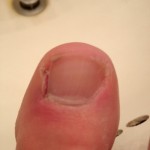 Ingrown Toenail Surgery & Post Op Care 18 Day9 RightToeAfterBrushing 150x150 Ingrown Toenail Surgery & Post Op Care
