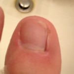 Ingrown Toenail Surgery & Post Op Care 19 Day9 LeftToeAfterBrushing 150x150 Ingrown Toenail Surgery & Post Op Care