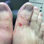 Ingrown Toenail Surgery & Post Op Care 2 AfterTheShots1 150x150 Ingrown Toenail Surgery & Post Op Care