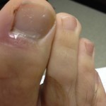 Ingrown Toenail Surgery & Post Op Care 20 Day10 DressingApplied 150x150 Ingrown Toenail Surgery & Post Op Care