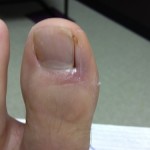 Ingrown Toenail Surgery & Post Op Care 21 Day10 LeftToeDressingApplied 150x150 Ingrown Toenail Surgery & Post Op Care