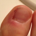 Ingrown Toenail Surgery & Post Op Care 21 Day11 PreBrushing 150x150 Ingrown Toenail Surgery & Post Op Care