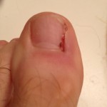 Ingrown Toenail Surgery & Post Op Care 22 Day11 LeftToePreBrushing 150x150 Ingrown Toenail Surgery & Post Op Care