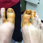 Ingrown Toenail Surgery & Post Op Care 3 IodineIThink1 150x150 Ingrown Toenail Surgery & Post Op Care