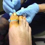 Ingrown Toenail Surgery & Post Op Care 4 SeparateTheNail1 150x150 Ingrown Toenail Surgery & Post Op Care