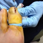 Ingrown Toenail Surgery & Post Op Care 6 MoreNailCleaving1 150x150 Ingrown Toenail Surgery & Post Op Care