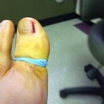 Ingrown Toenail Surgery & Post Op Care 7 NoMoreIngrown1 150x150 Ingrown Toenail Surgery & Post Op Care