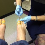 Ingrown Toenail Surgery & Post Op Care 8 IngrownRemoval1 150x150 Ingrown Toenail Surgery & Post Op Care