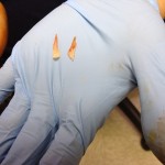 Ingrown Toenail Surgery & Post Op Care 9 RemovedNails 150x150 Ingrown Toenail Surgery & Post Op Care