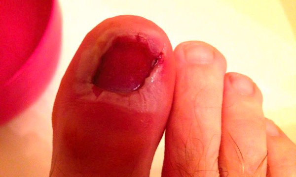 Ingrown Toenail Removal Surgery Infection